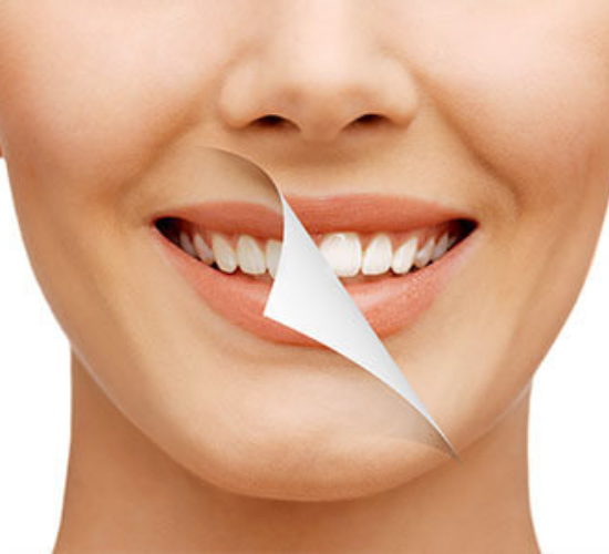 Teeth Whitening