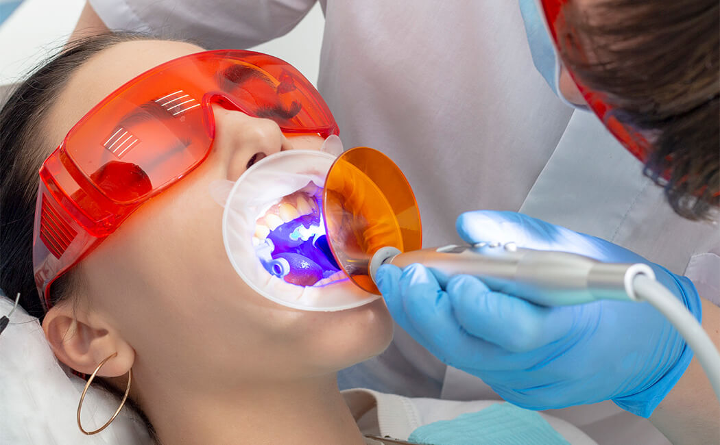 Tips after Veneers Treatment