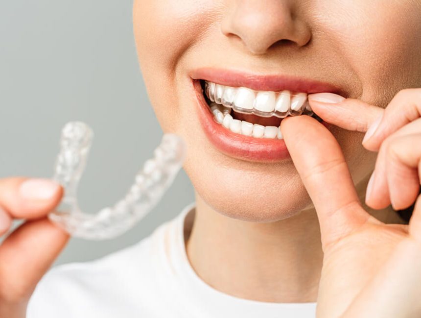 Dental Crowns