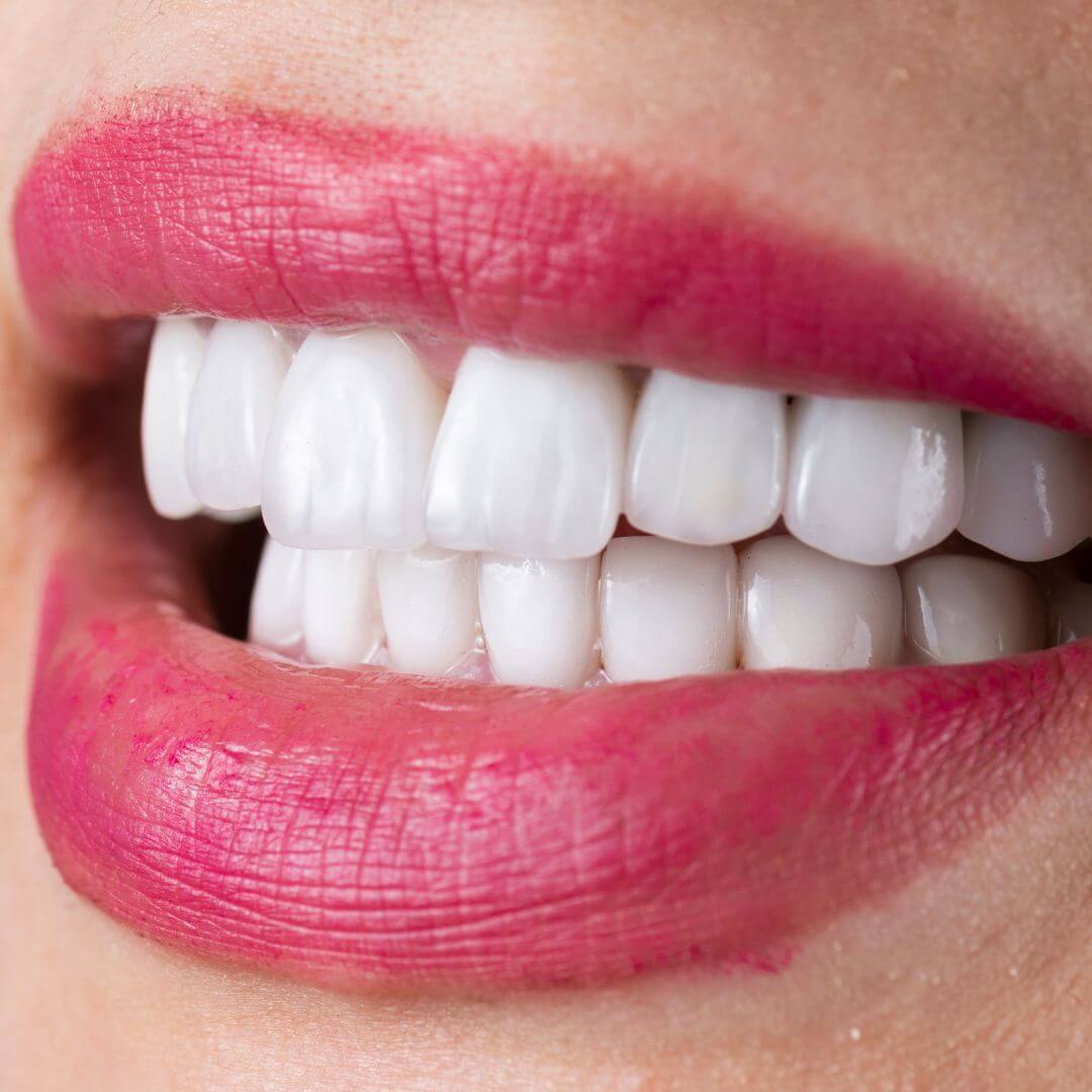 Tips after Esthetic Restorations
