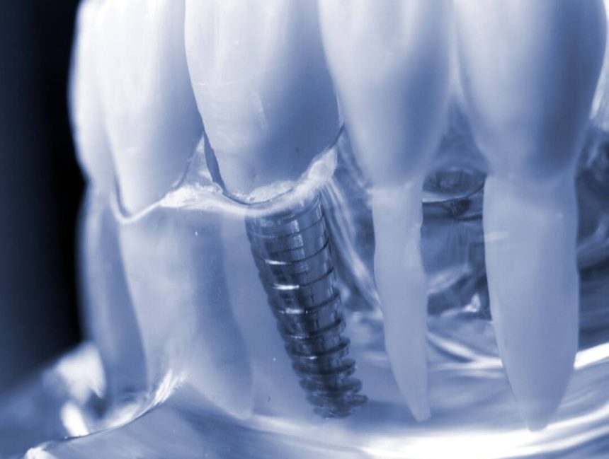 From Chips to Gaps: How Dental Implants Can Improve Your Dental Health